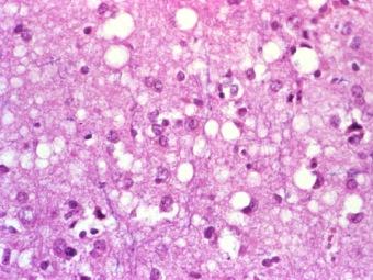 Поражение нервной ткани при болезни Крейтцфельда-Якоба. Изображение с сайта pathology.mc.duke.edu
